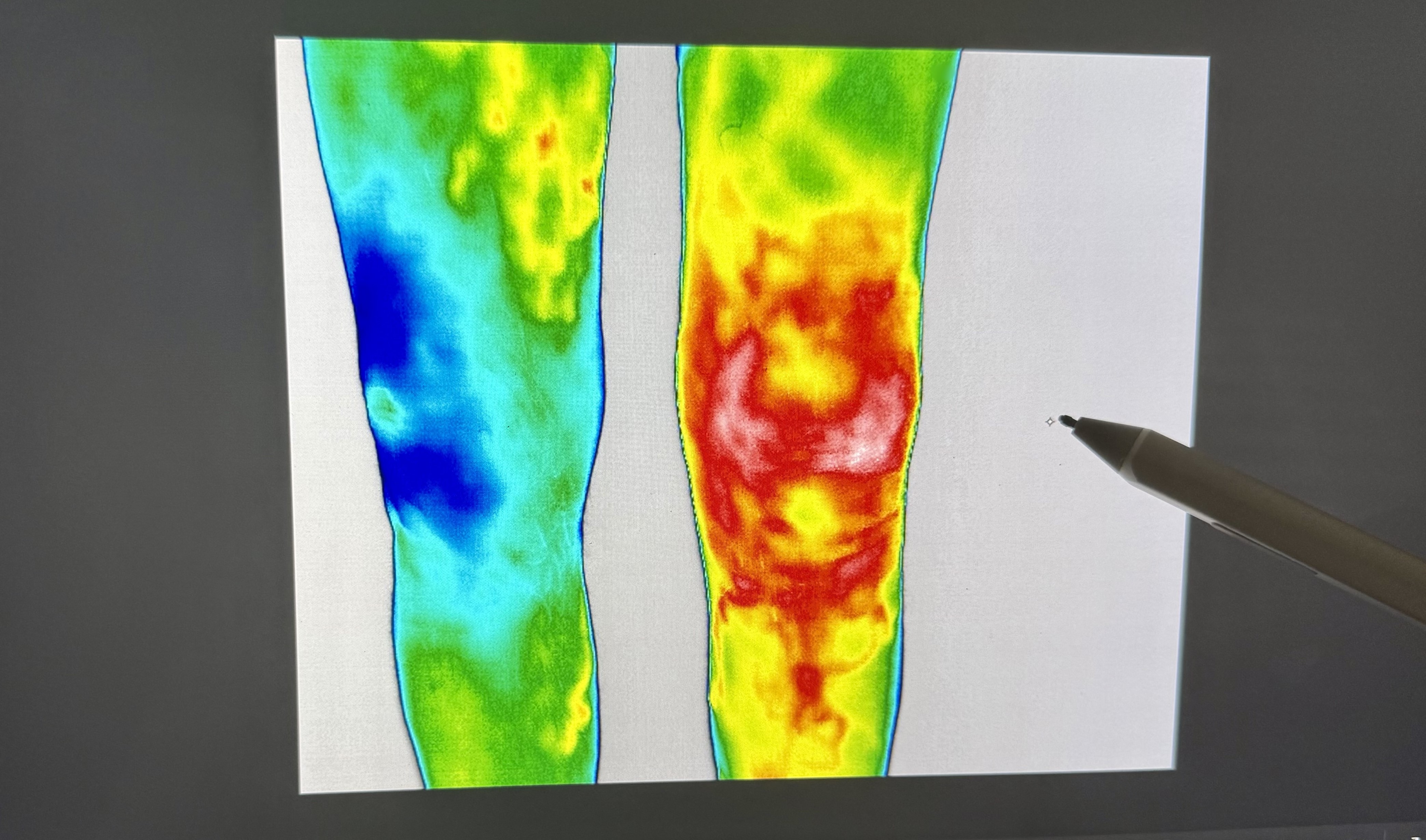 Thermal Imaging treatment at Adept Physical Therapy